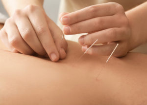 Chesapeake Pain Management acupuncture